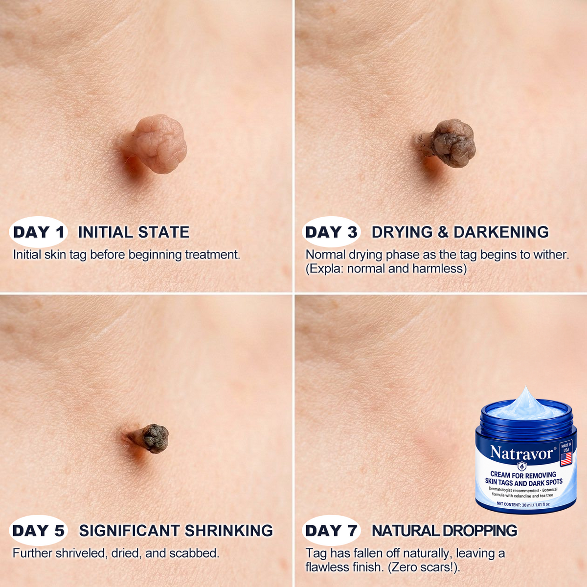 💎💎Natravor® 7-𝐃𝐚𝐲 𝐒𝐤𝐢𝐧 𝐓𝐚𝐠 & 𝐒𝐩𝐨𝐭 𝐄𝐫𝐚𝐬𝐞𝐫 𝐂𝐫𝐞𝐚𝐦 (Zero Pain, Zero 𝐒𝐜𝐚𝐫𝐬 Formula) 💎