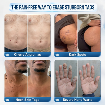 💎💎Natravor® 7-𝐃𝐚𝐲 𝐒𝐤𝐢𝐧 𝐓𝐚𝐠 & 𝐒𝐩𝐨𝐭 𝐄𝐫𝐚𝐬𝐞𝐫 𝐂𝐫𝐞𝐚𝐦 (Zero Pain, Zero 𝐒𝐜𝐚𝐫𝐬 Formula) 💎